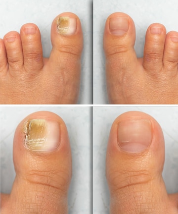How to Treat and Prevent Brittle Toenails